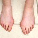 En algunos casos los juanetes causan mucho dolor. Foto: Getty Images.