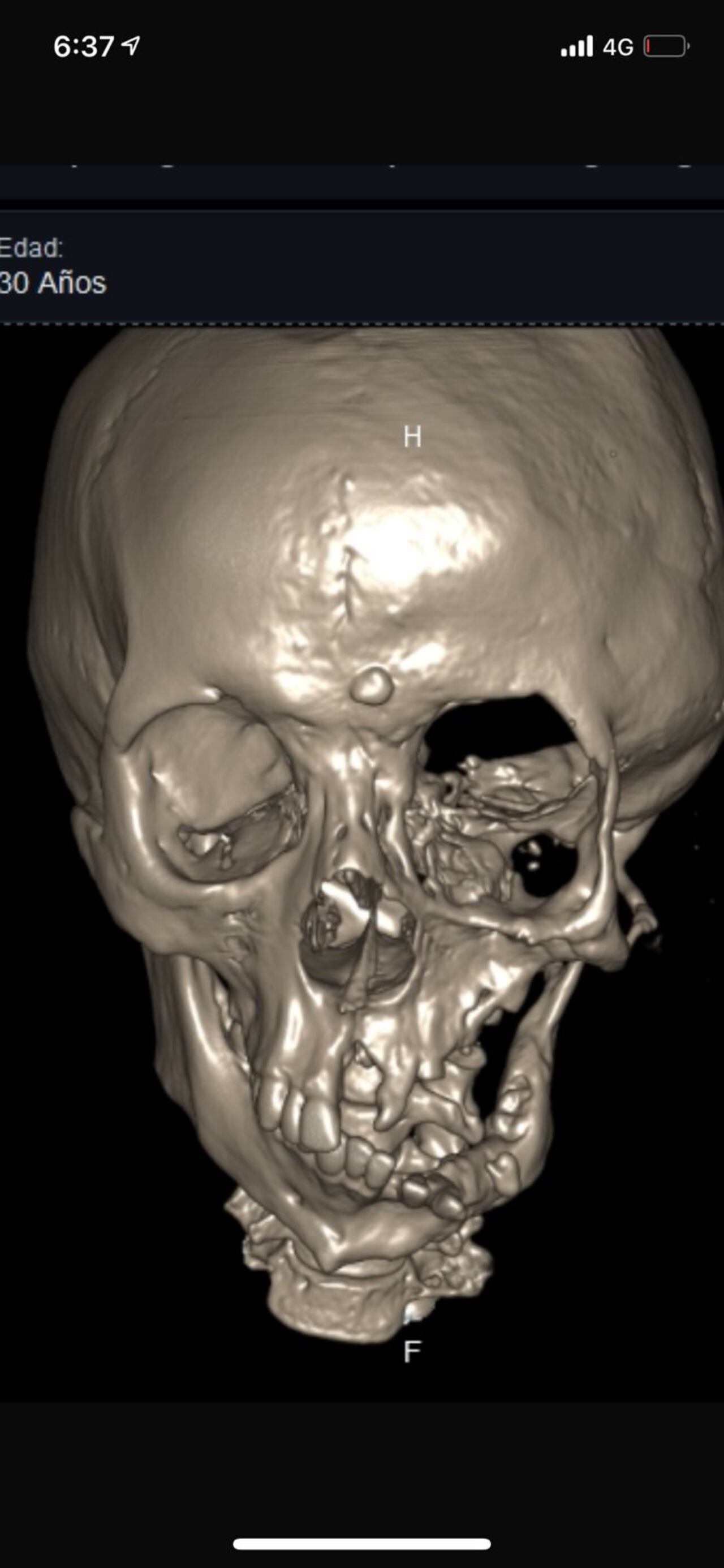 Sandra Milena Micán, la esperanza de un milagro