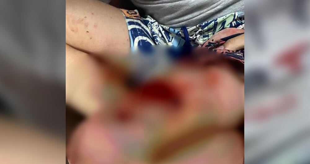 Los tres menores de edad se recuperan de las graves lesiones que les ocasionó el perro.