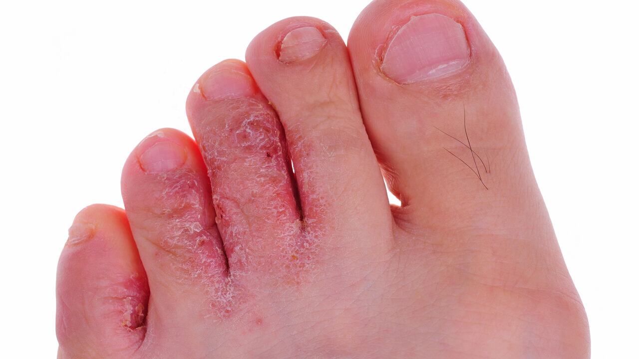 Los hongos en las uñas pueden aparecer por no usar zapatos adecuados en lugares públicos.