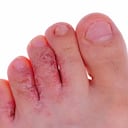 Los hongos en las uñas pueden aparecer por no usar zapatos adecuados en lugares públicos.