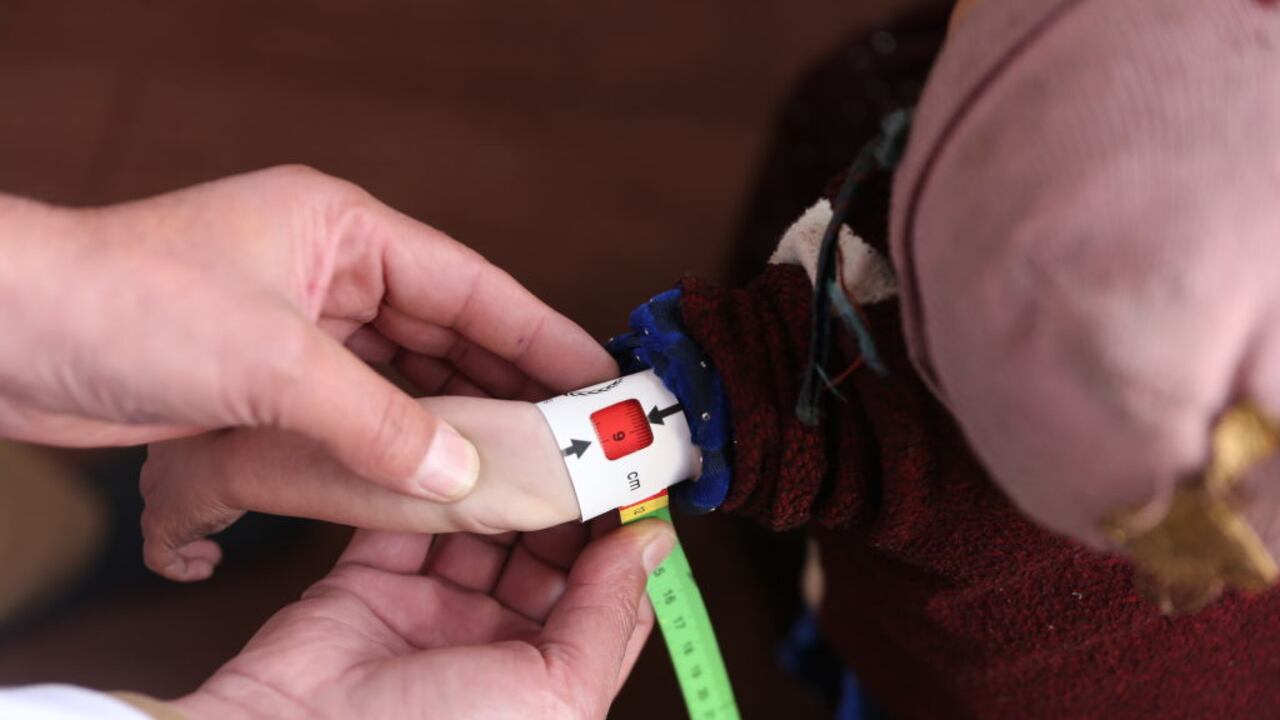 Nezmin Terahil, un bebé afgano desnutrido de 18 meses, es visto durante un proceso de control de salud y tratamiento en el Hospital de Salud Infantil Indira Gandhi en Kabul, Afganistán, el 10 de diciembre de 2022 (Foto de Bilal Guler/Agencia Anadolu vía Getty Images)
