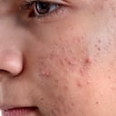 Acné: Síntomas, causas y mitos sobre esta afección cutánea en la piel