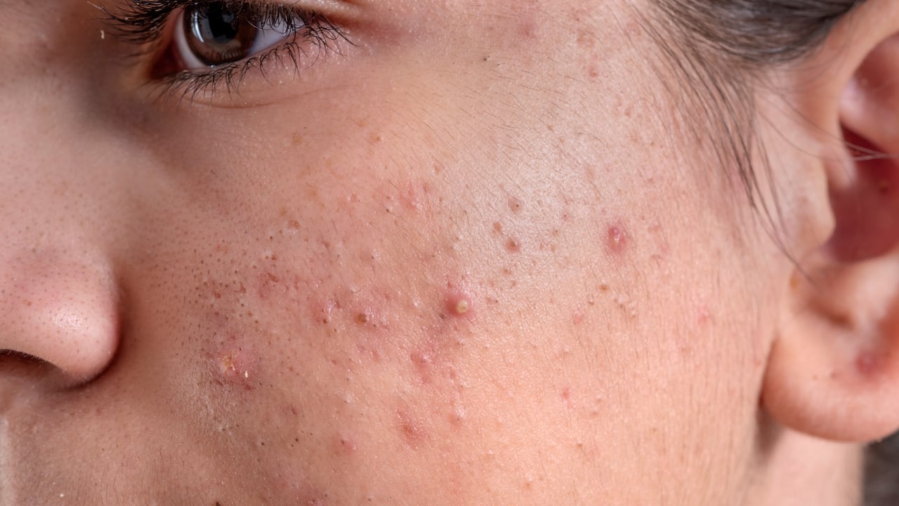 ¿Las pastillas anticonceptivas ayudan a quitar el acné?