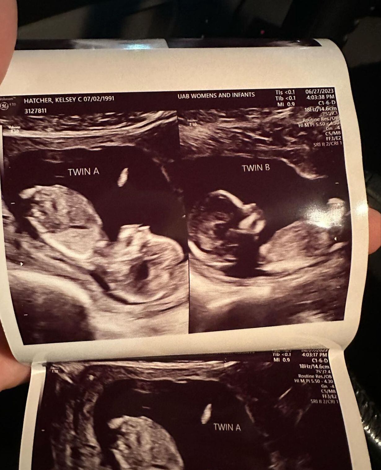 Ecografía de los dos úteros