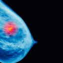 El cáncer de seno es muy frecuente en las mujeres.