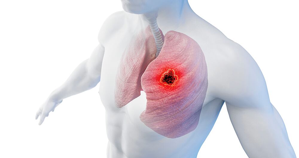 La incidencia de cáncer se relaciona de manera directa con el Índice de Desarrollo Humano