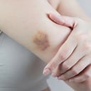 Los hematomas se generan porque se rompen vasos sanguíneos debajo de la piel.