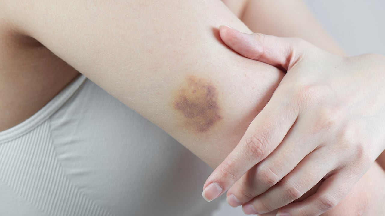 Los hematomas se generan porque se rompen vasos sanguíneos debajo de la piel.