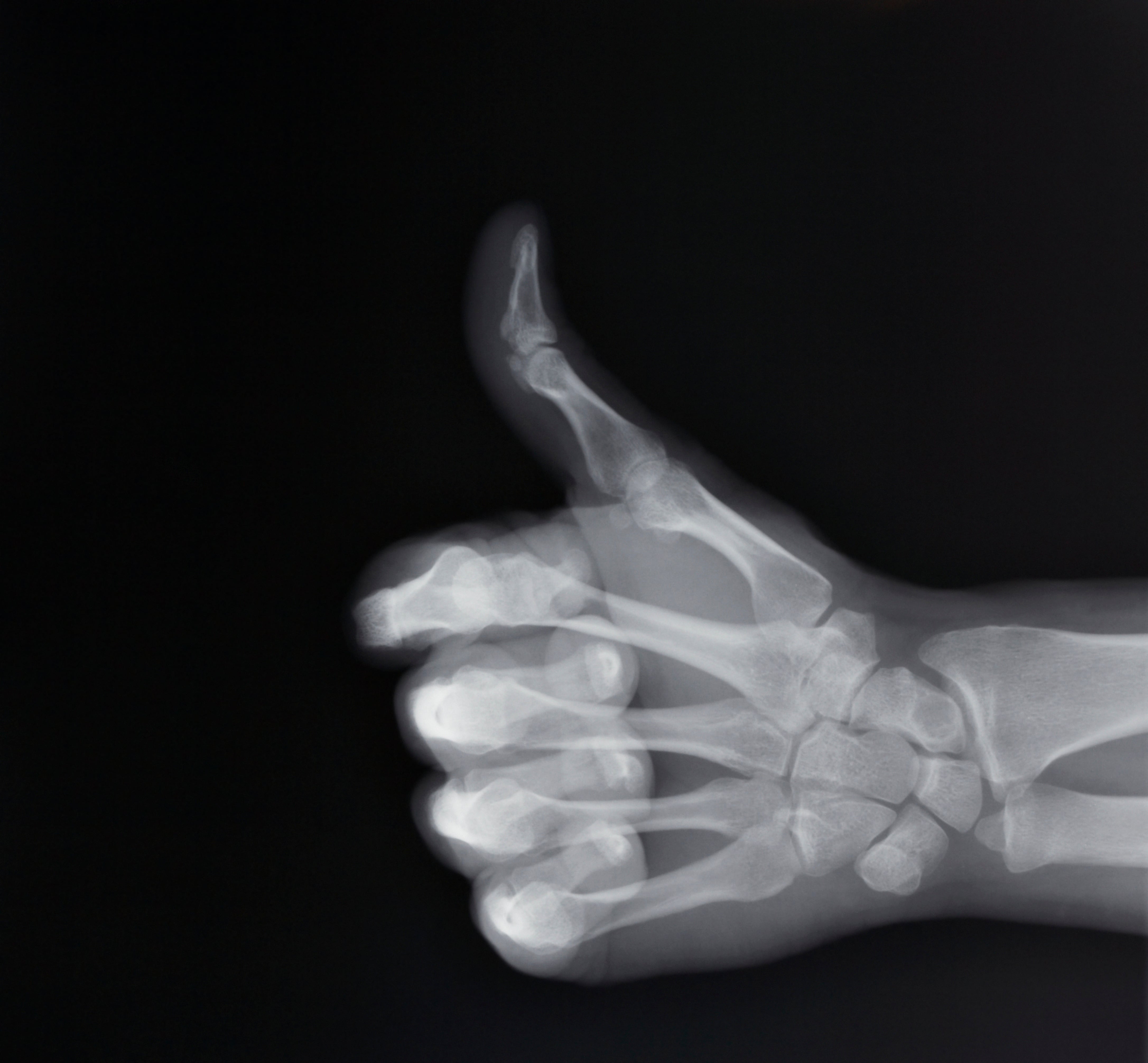 X-ray of hand making thumbs up gesture