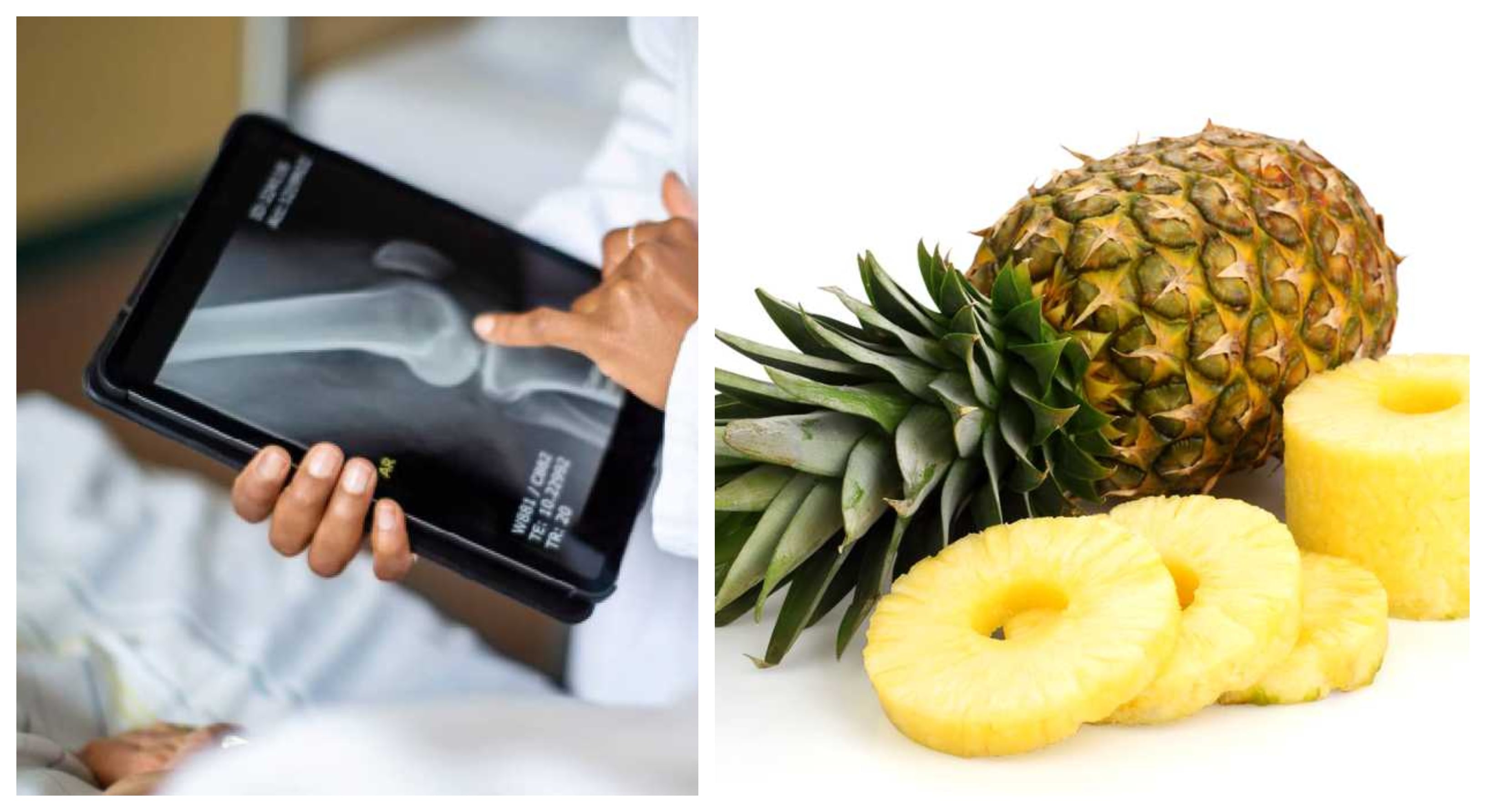 La piña es rica en vitaminas A, C, B6 y E. Foto: Getty Images, montaje SEMANA.