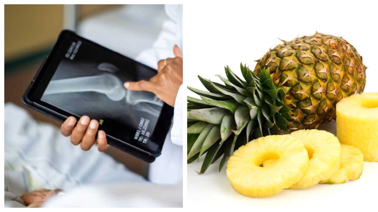 La piña es rica en vitaminas A, C, B6 y E. Foto: Getty Images, montaje SEMANA.