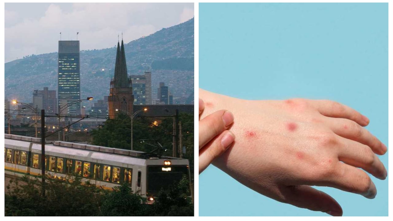 En Medellín se detectó uno de los tres casos que hay registrados en Colombia de viruela del mono, los otros dos están en Bogotá. Foto: Luis Benavides Getty Images. Montaje SEMANA.