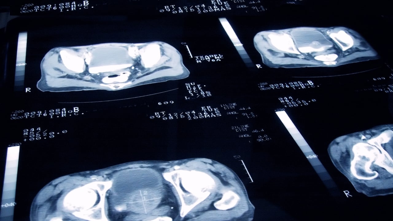 Radiografía de un examen de cáncer de próstata.