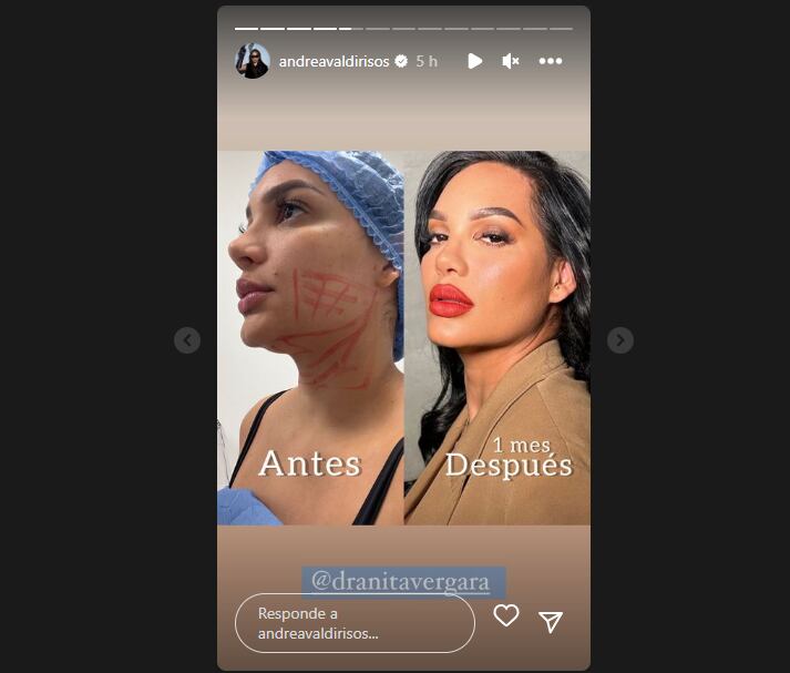 La influencer mostró el paso a paso de su cirugía estética