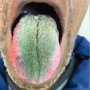 Las principales causas, según la hipótesis de los expertos al presentar el caso extraño, son la ingesta de antibióticos y de consumo excesivo de tabaco sin una debida higiene oral.