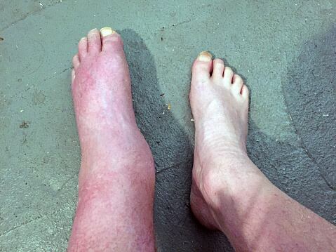 El consumo excesivo de sal puede provocar retención de líquidos.