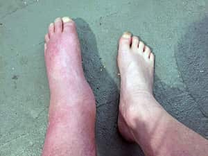 El consumo excesivo de sal puede provocar retención de líquidos.