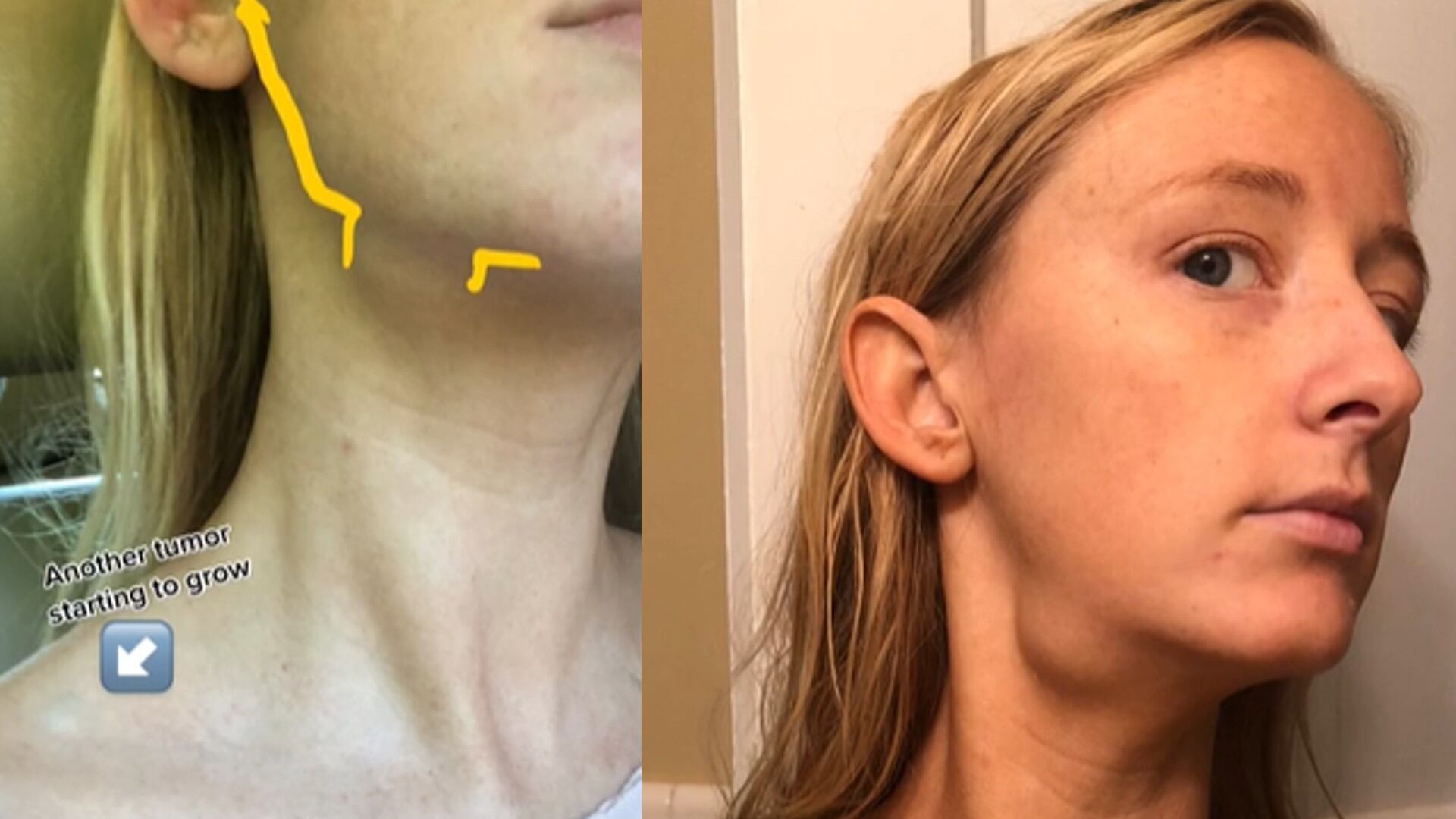 Los tumores fueron detectados en varias partes del cuerpo.