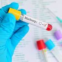 Muestra de sangre positiva con virus de Marburgo