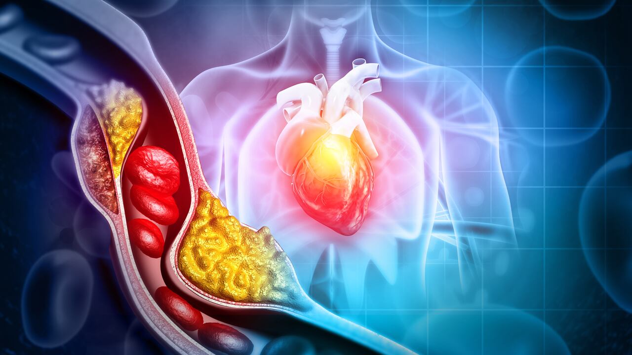 El colesterol alto puede provocar un ataque cardíaco.