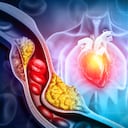 El colesterol alto puede provocar un ataque cardíaco.