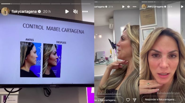 Mabel Cartagena y su cambio tras retoque estético.