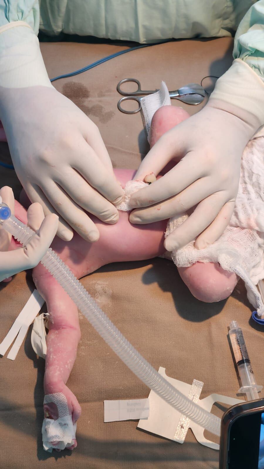 El bebé tenía un defecto en la pared abdominal.