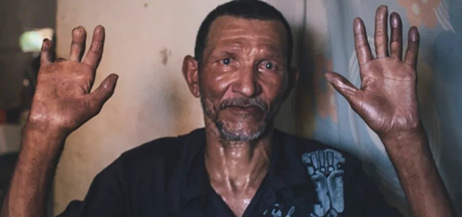 La lepra puede aparecer años después de hacer contacto con un paciente contagiado.