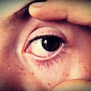 Los espasmos del párpado, también conocidos como mioquimia, son generalmente inofensivos y suelen desaparecer por sí solos en unos pocos días o semanas.