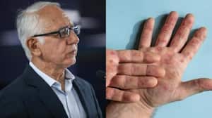 Ministro de Salud y Protección Social, Guillermo Alfonso Jaramillo, se refirió al tema de la viruela del mono.