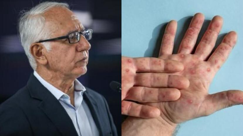 Ministro de Salud y Protección Social, Guillermo Alfonso Jaramillo, se refirió al tema de la viruela del mono.