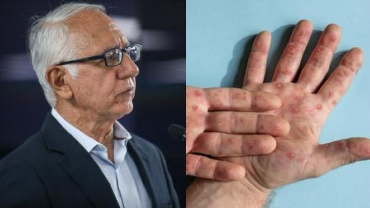 Ministro de Salud y Protección Social, Guillermo Alfonso Jaramillo, se refirió al tema de la viruela del mono.
