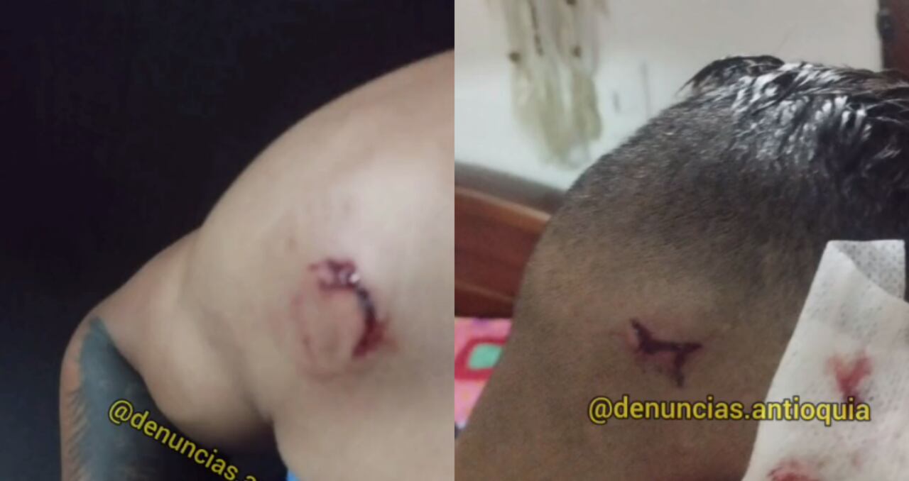 Heridas que causó la persecución en Medellín, en medio de un robo que se hace viral en las redes sociales.