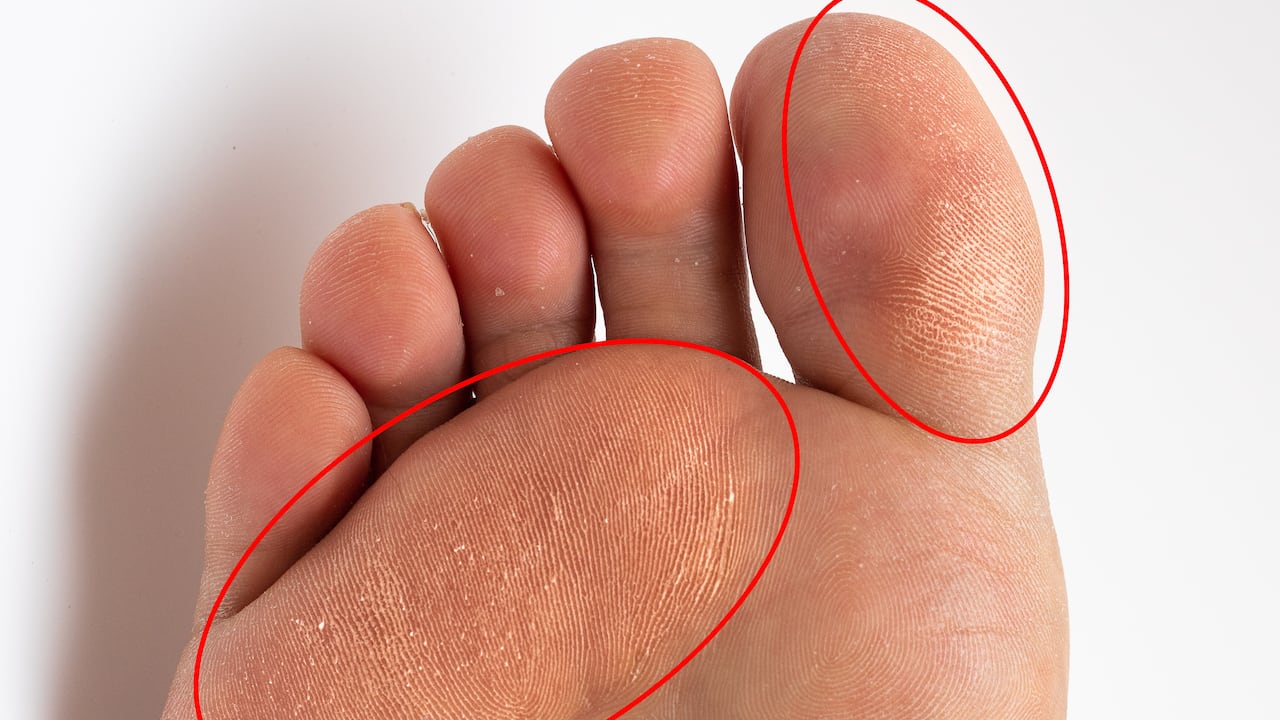 Los callos en los pies pueden aparecer por diversas razones.