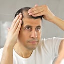 La calvicie puede iniciar a los 30 años de edad o antes.