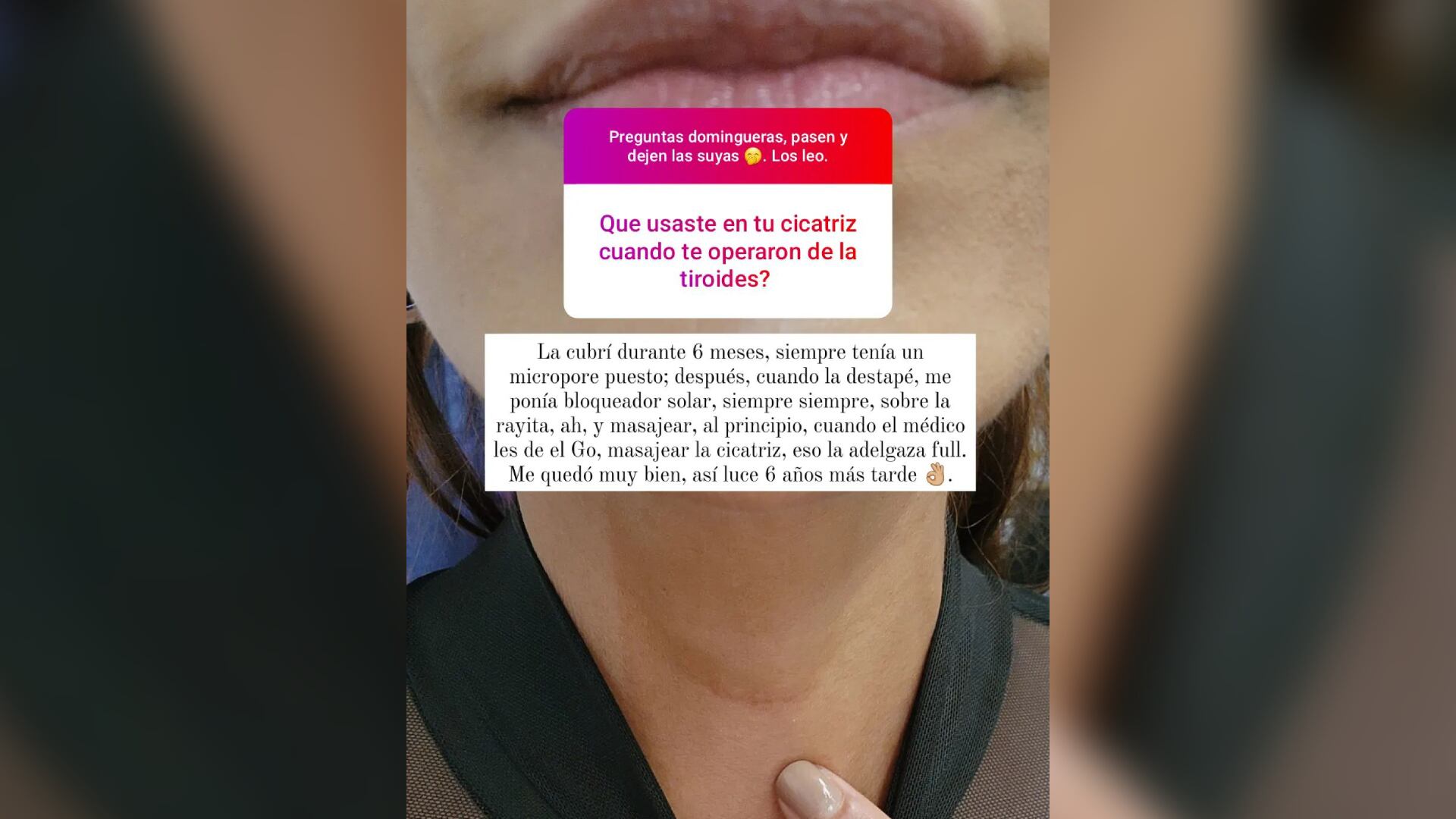 Así luce la cicatriz de Andrea Serna tras 6 años de haberse sometido a una cirugía en la que extirparon las tiroides.