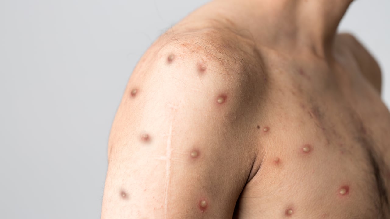 Valledupar ya reporta dos casos de viruela del mono Foto: Getty Images. Referencia