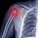 Rayos X del hueso del hombro derecho.