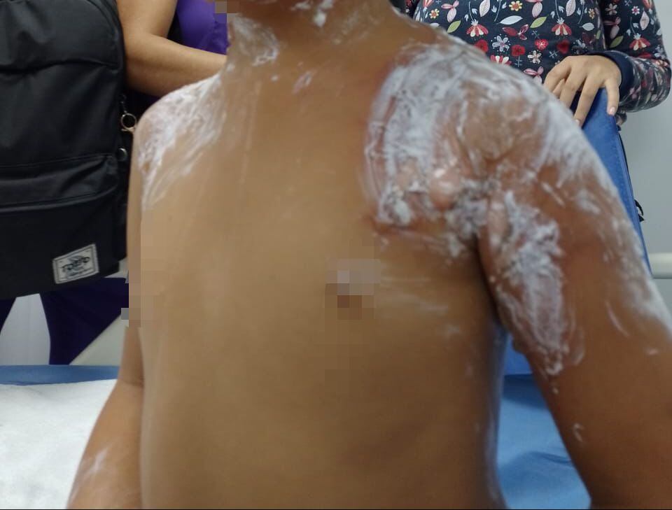 Las quemaduras se registraron en la cara y en el cuerpo.
