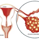 El cáncer de ovario no se encuentra entre el mencionado grupo de tipos de cáncer priorizados en el Plan Decenal para el Control de Cáncer en Colombia 2012-2021