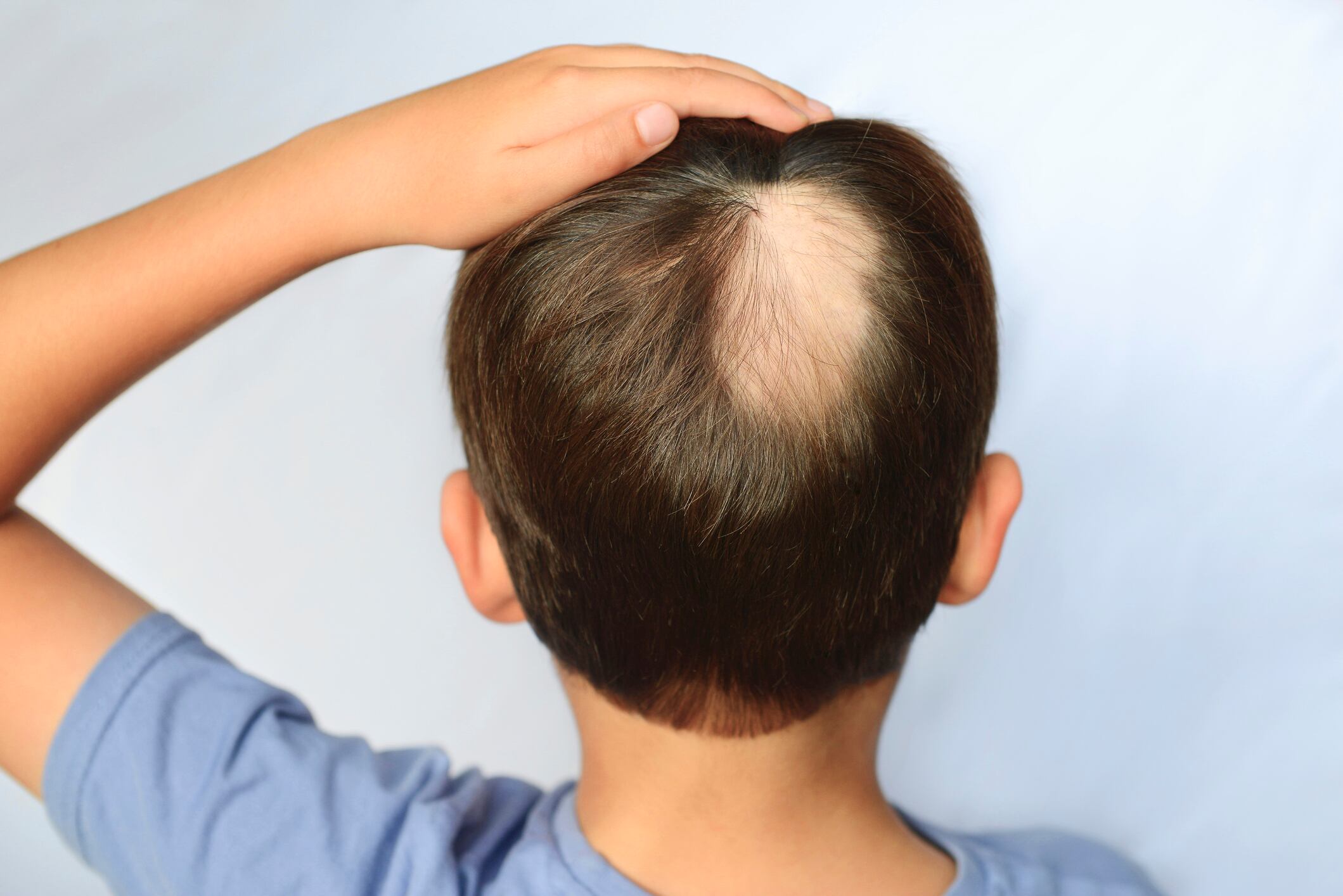 La aparición de huecos en el cabello o la barba es un problema multifactorial que puede derivar de condiciones médicas o hábitos diarios. Dermatólogos y expertos en salud capilar explican las causas y comparten consejos preventivos.