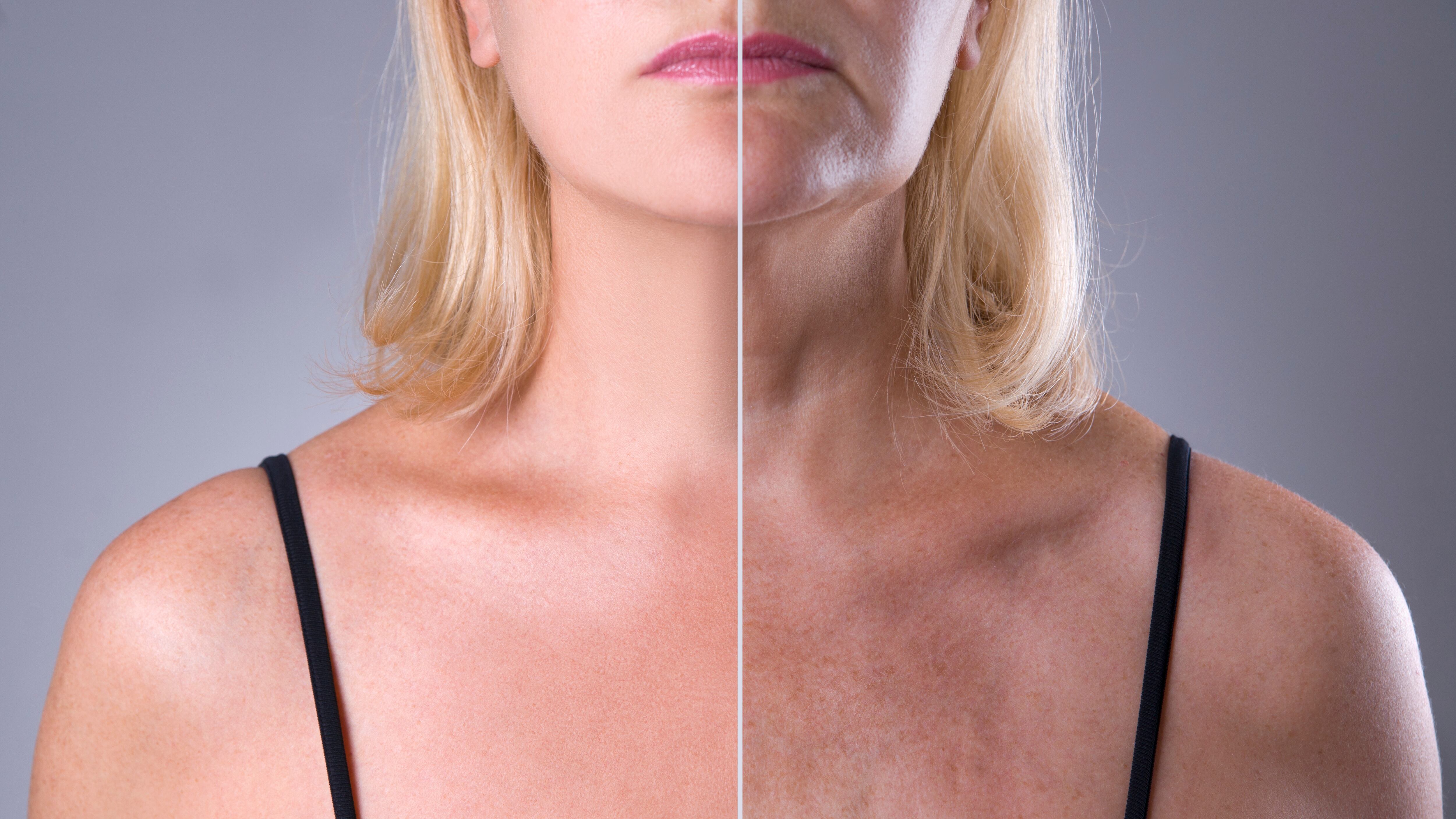 Arrugas en el escote