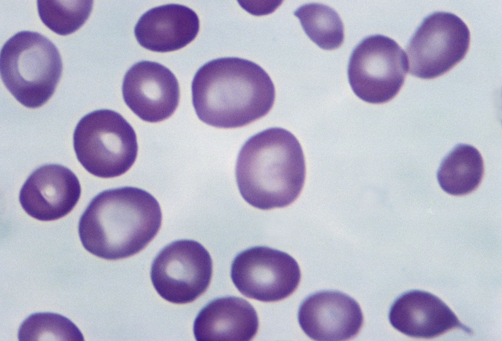Anemia perniciosa. Glóbulos rojos macrocíticos, 500X a 35 mm - Imagen de referencia