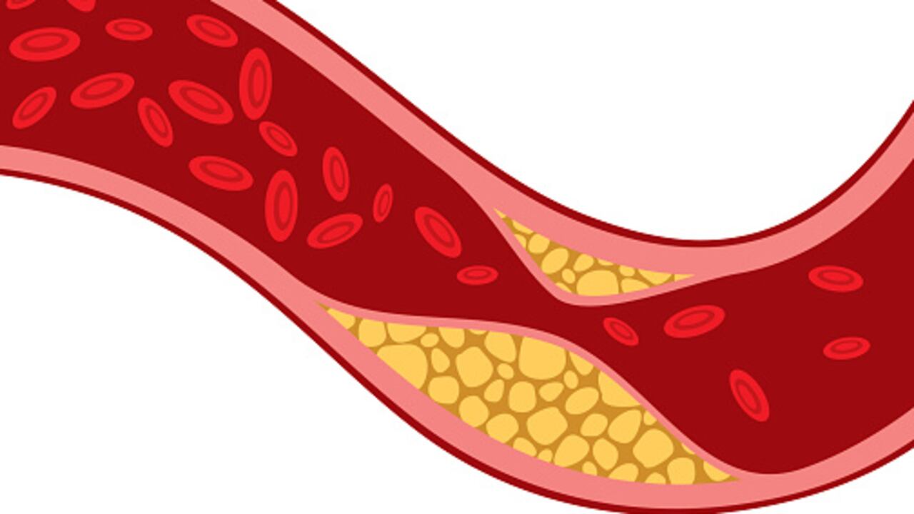 El colesterol LDL se incrementa por un plan de alimentación rico en grasa.