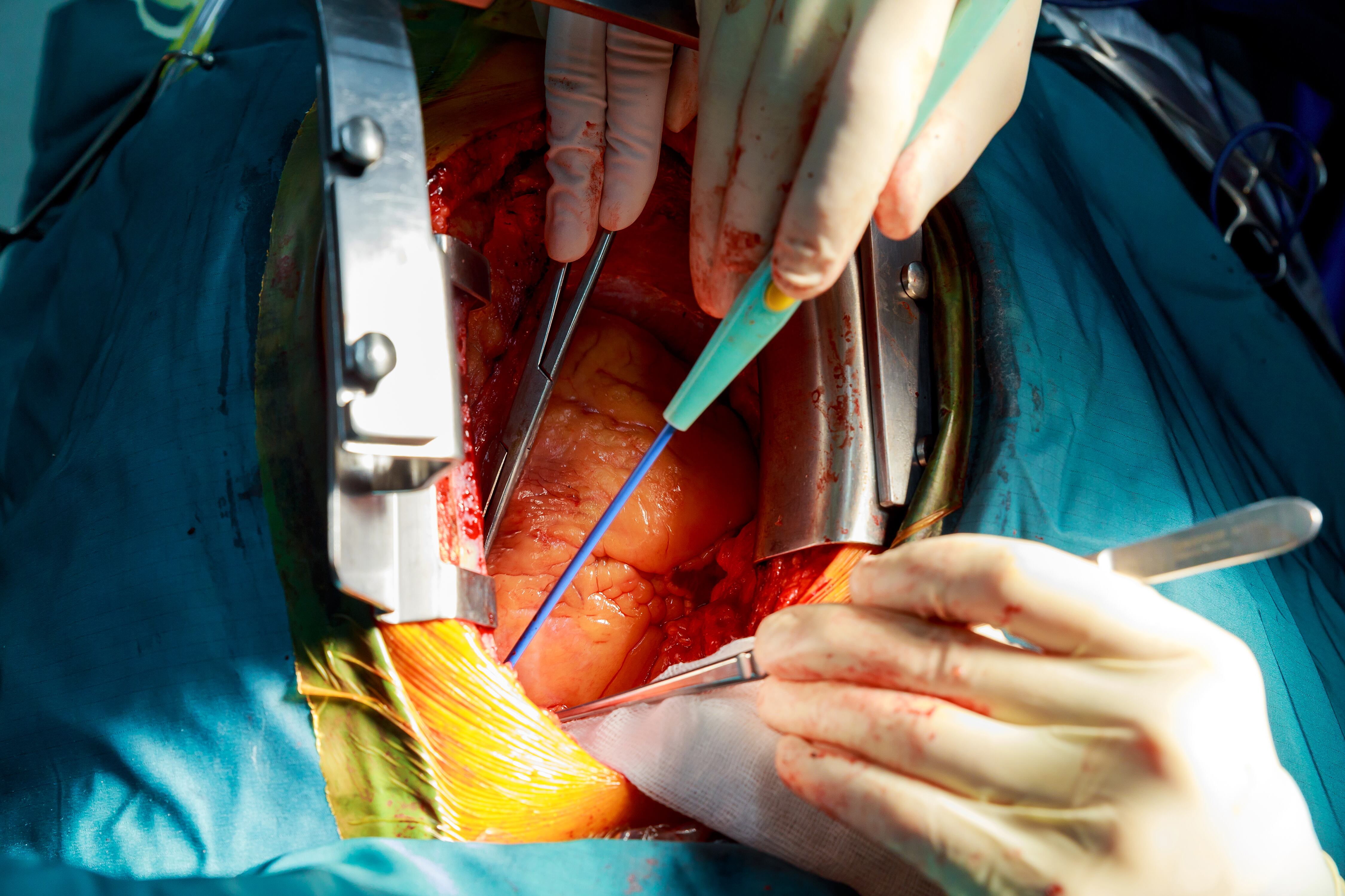 Trafico de órganos.