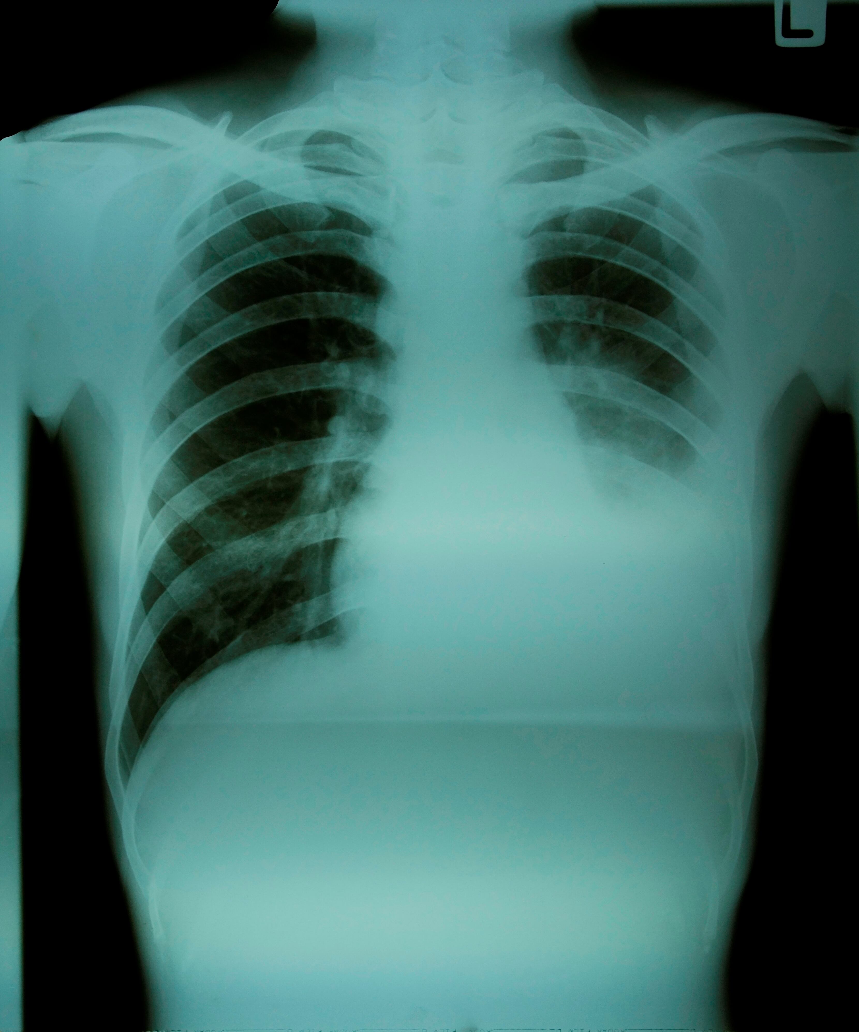 Foto referencia sobre cáncer de pulmón.