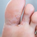 Los hongos en los pies pueden prevenirse adoptando algunas medidas higiénicas.