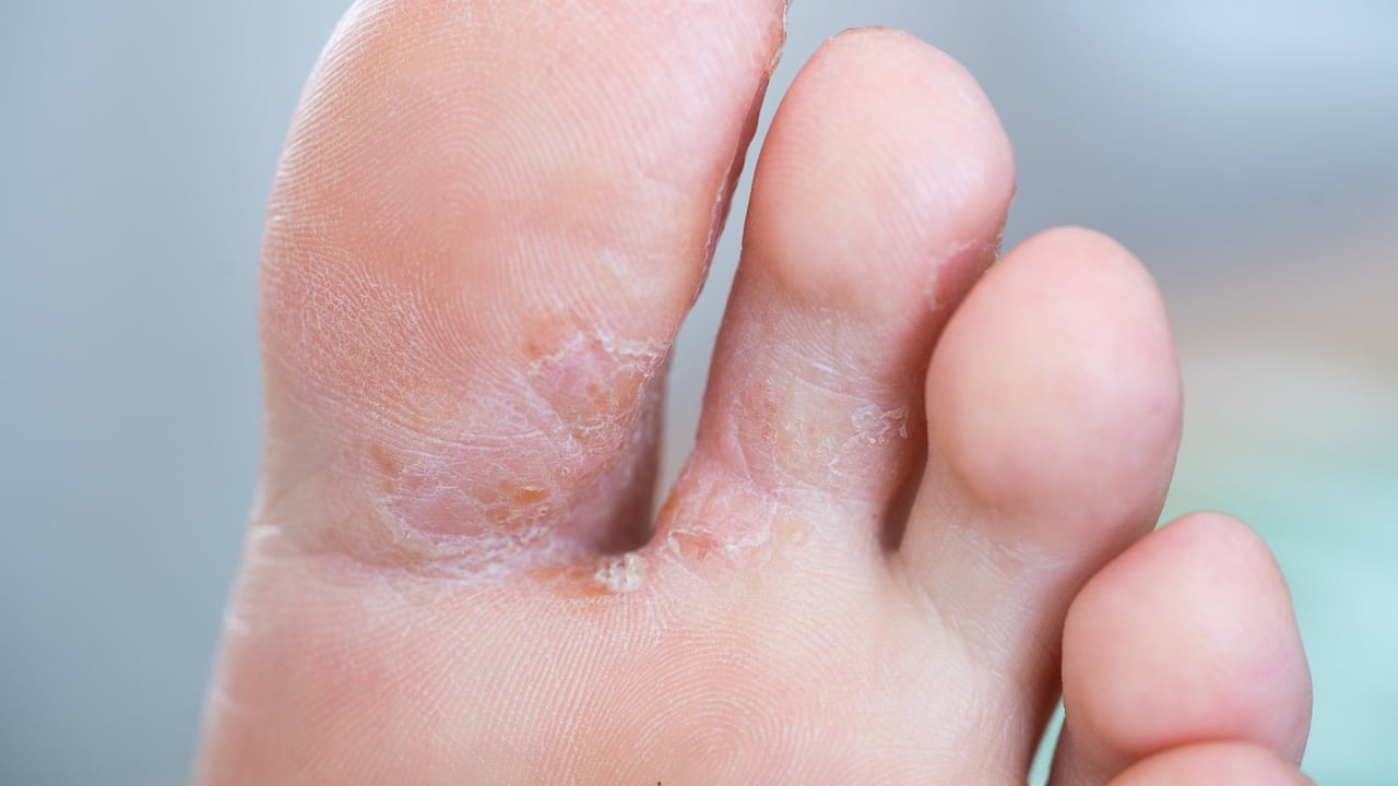 Dependiendo de varias razones, las bacterias de las uñas, entre los dedos o en la planta, pueden causar complicaciones, tanto sociales como de salud.