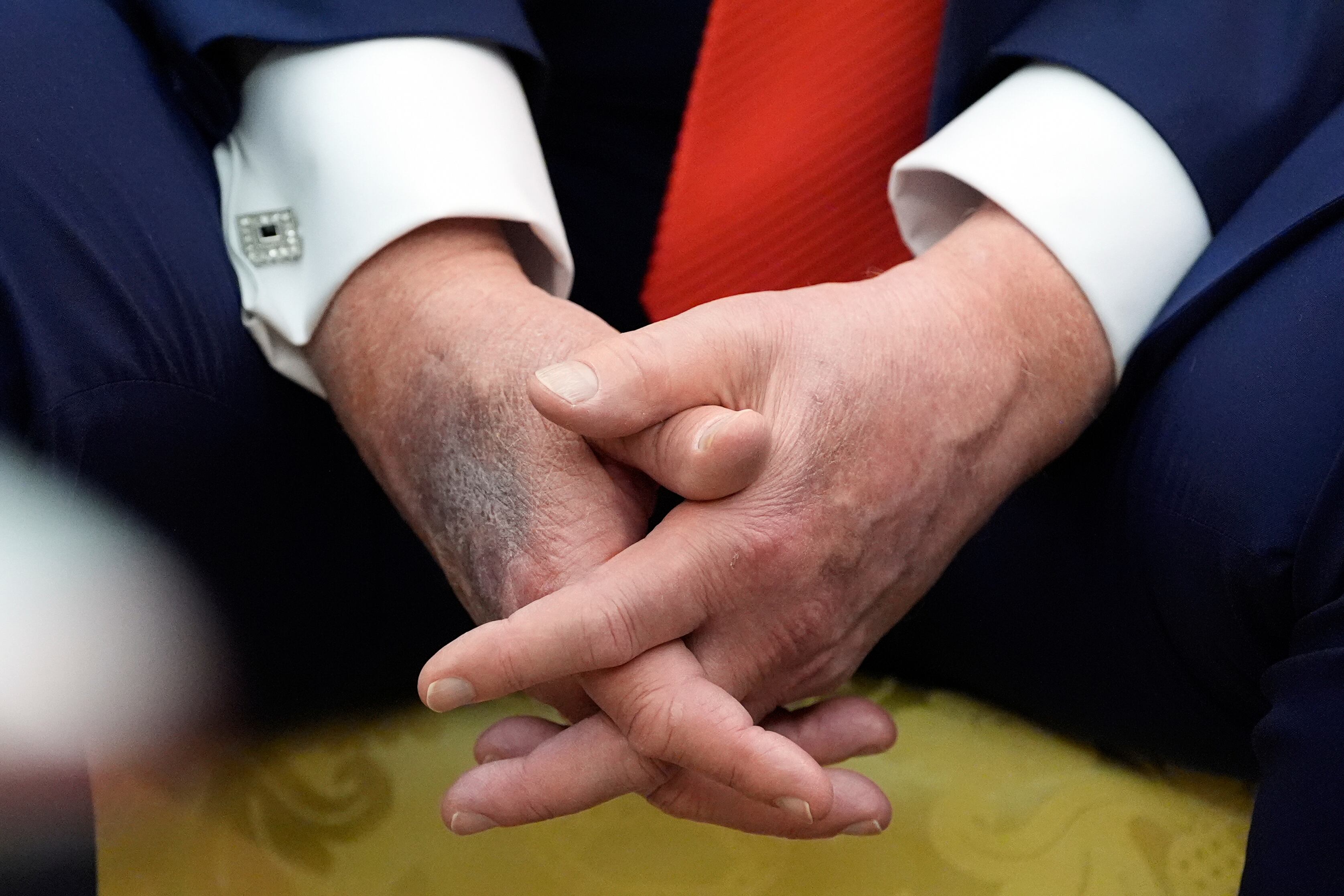 Así se veía la mano de Donadl Trump durante su reunión con el presidente de Corea del Sur, Lee Jae Myung.